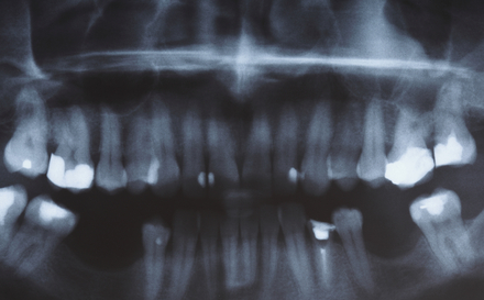 X-ray scan of humans teeth