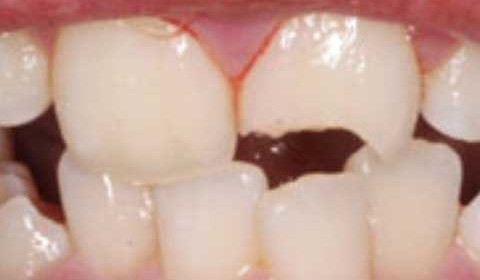 repaired broken tooth