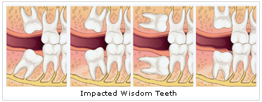 wisdom_teeth_removal_dentistry_service_dental_care_professionals wisdom teeth removal dentistry service dental care professionals