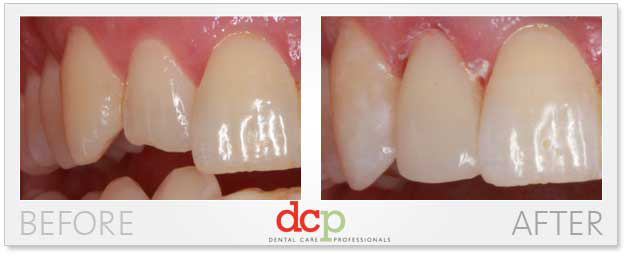 Photos before and after dentist visit for fixing broken tooth. Veeners before and after