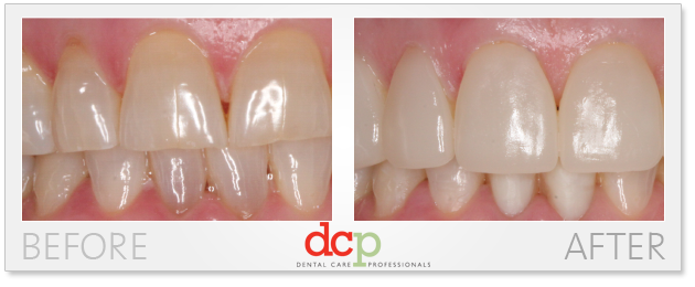 before-after-cerec-veneers veeners before and after