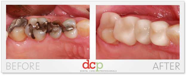 Photos before and after dentist visit for porcelain onlays crown dental treatment to replace amalgam fillings with natural colour fillings. Crowns and Bridges before and after