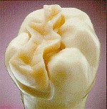 inlay-onlay inlays onlays