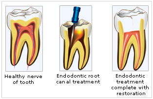 root_canal_dentistry_service_dental_care_professionalsl Root Canal Treatment