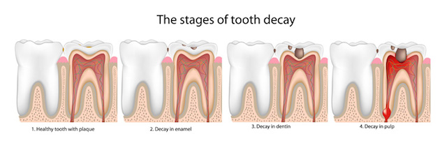 stages-of-tooth-decay stages of tooth decay