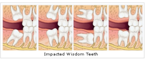 Wisdom Teeth Removal in Adelaide Wisdom Teeth Removal in Adelaide
