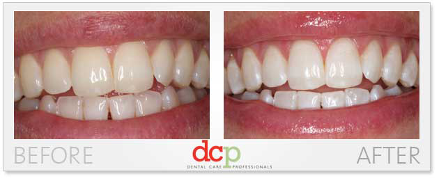 Photos from before and after dentist visit for teeth bleaching and professional teeth whitening with Philips Zoom whitening. Photos from before and after